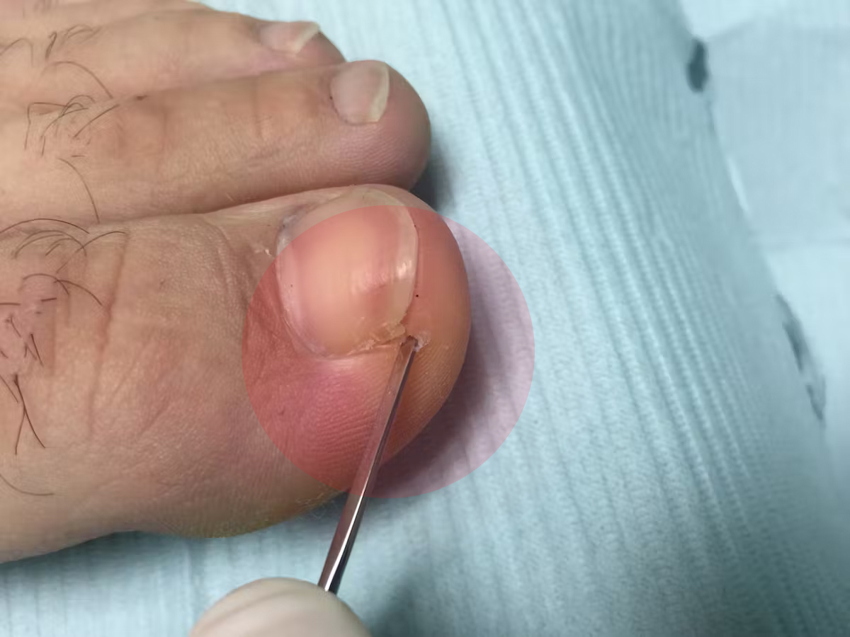 Prevention et soins des ongles incarnés des pieds